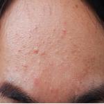 Fungal Acne Decoded: Why Your Regular Acne Treatments Aren,t Working on Those Tiny, Itchy Forehead Bumps