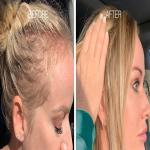 Postpartum Hair Loss: Causes and Remedies