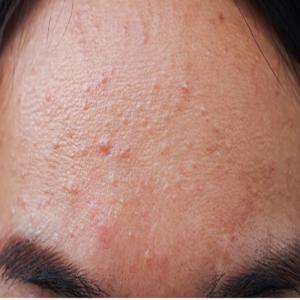 Fungal Acne Decoded: Why Your Regular Acne Treatments Aren,t Working on Those Tiny, Itchy Forehead Bumps